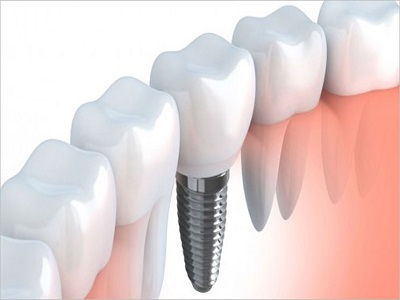 Dental Bone Grafts Which is the ideal Biomaterial